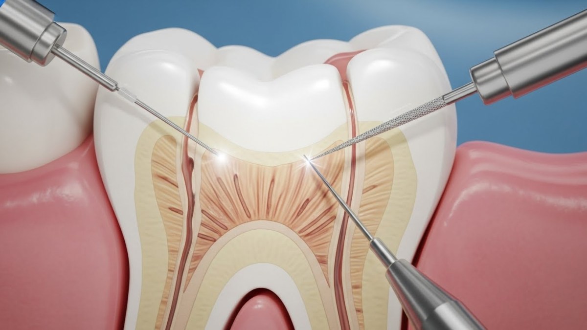 Top Rated Endodontic Mission Viejo Care for Lasting Dental&nbsp;Health
